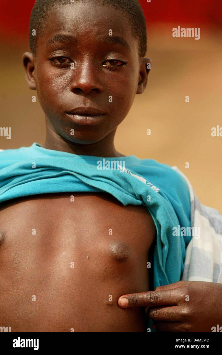 Alexandre Kalala aged 13 shows off his scars he got when he was fighting as a child soldier in the Congo civil war circa 2000 Stock Photo