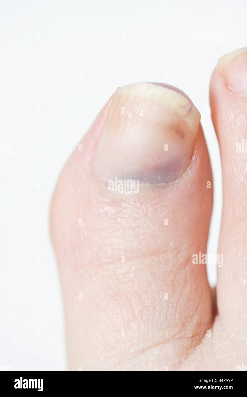 Bruised toenail hires stock photography and images Alamy