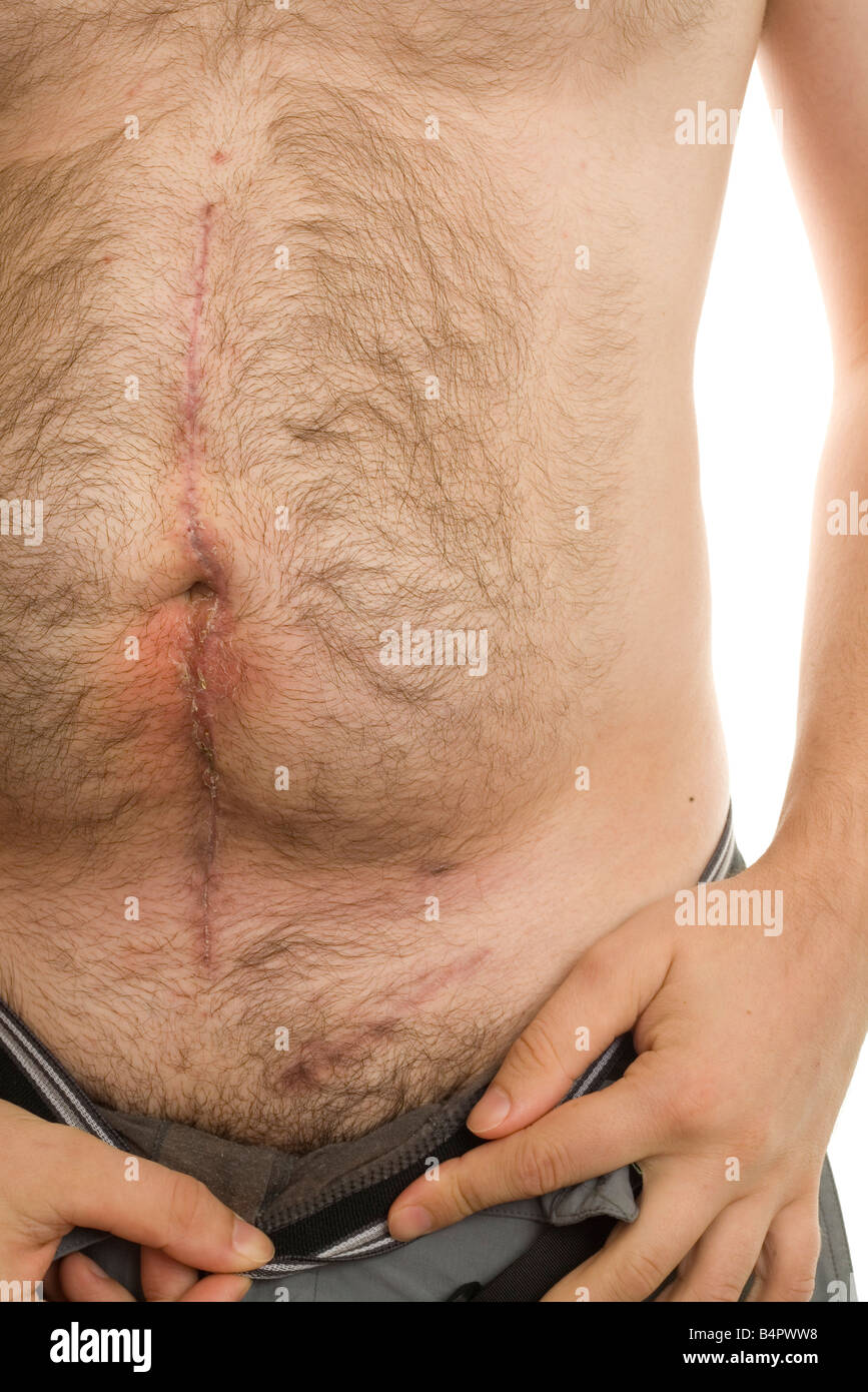 Orchiectomy High Resolution Stock Photography and Images - Alamy Orchiectomy High Resolution Stock Photography and Images - Alamy