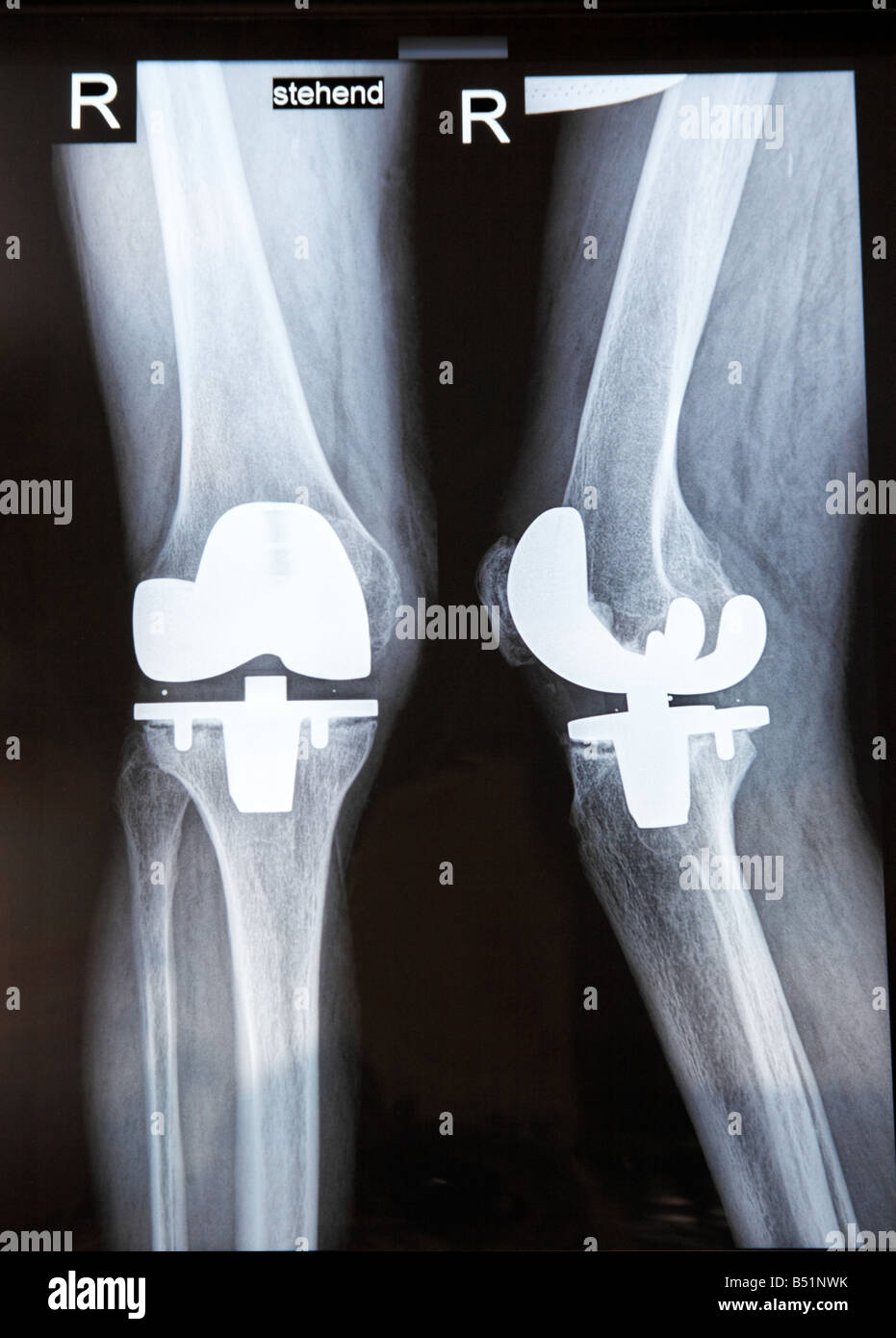 Xray image of an artificial knee joint Stock Photo Alamy
