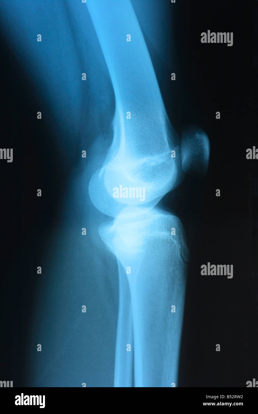 Lateral X ray of a 15 years old girl knee Stock Photo