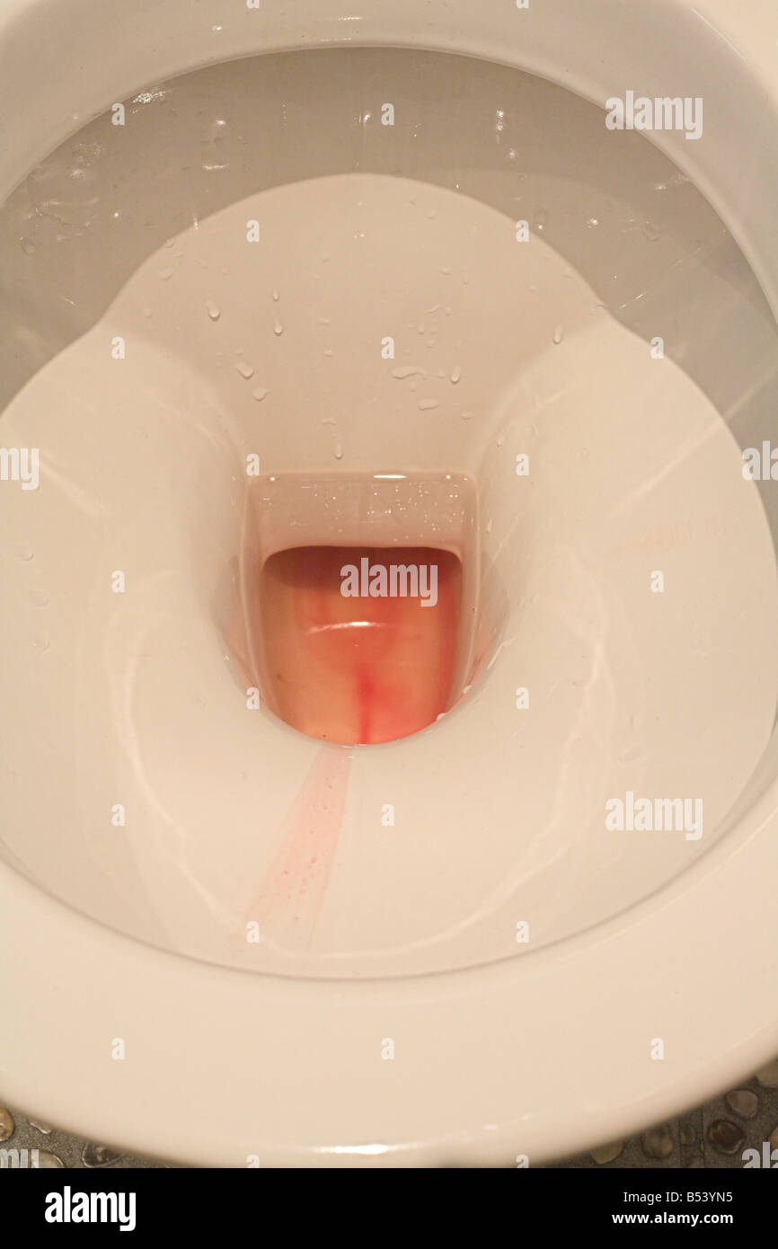 Download Kidney Stones In Toilet Free Images Www