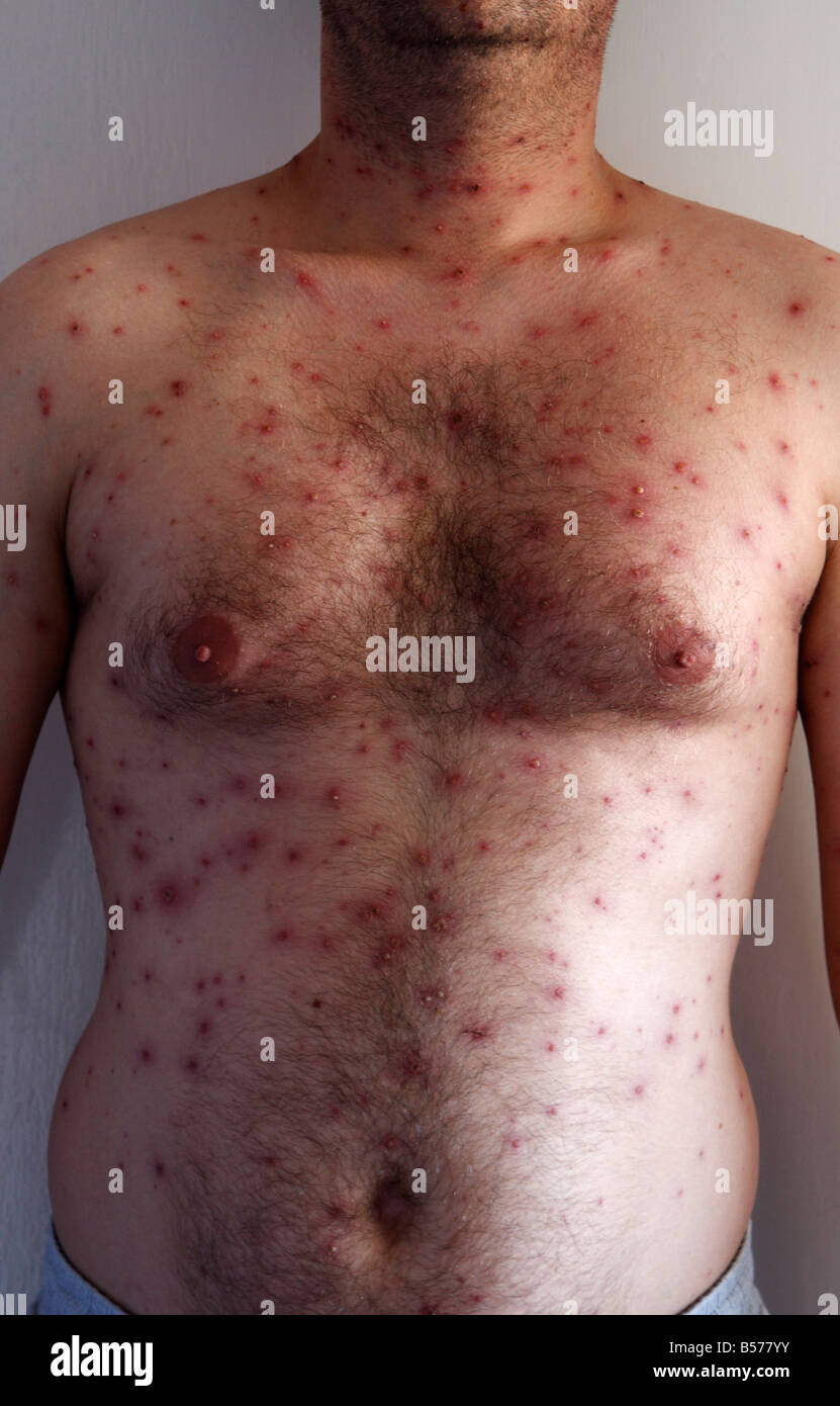 Chicken pox" virus, body of adult man covered in itchy red spots Stock  Photo - Alamy