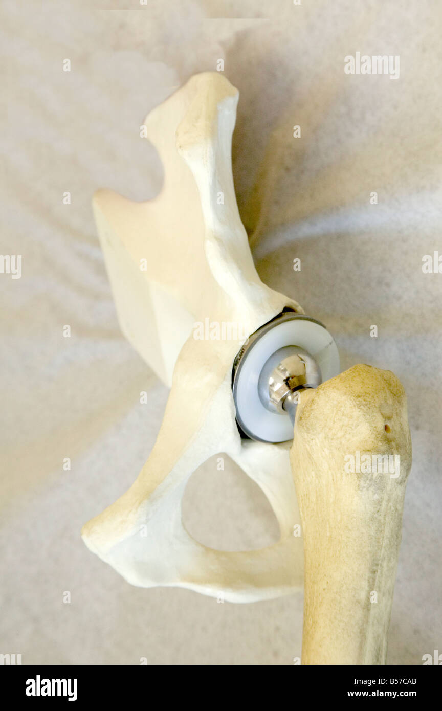 Total left hip arthroplasty (prosthesis), hip replacement. Stock Photo