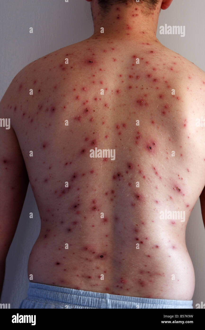 chicken pox pictures in adults