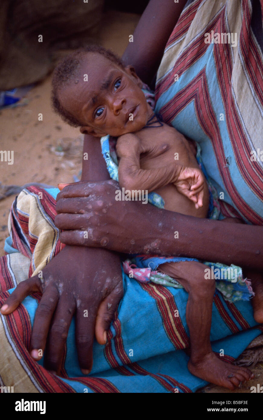 Emaciated baby in refugee camp in 1992, Mogadishu, Somalia, Africa Stock Photo