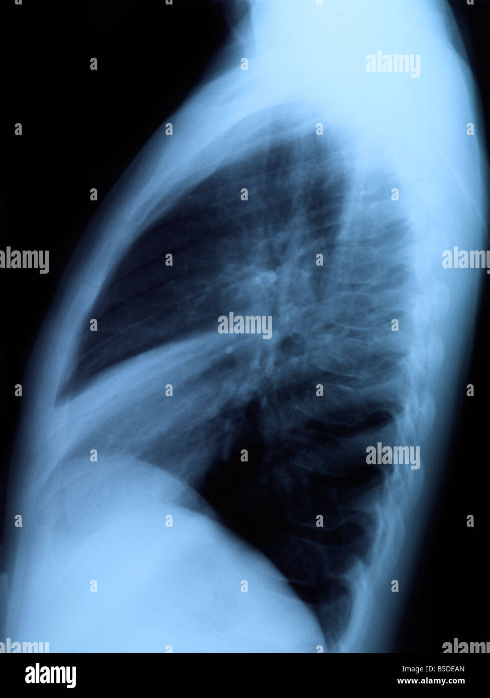 radiography of chest Stock Photo - Alamy