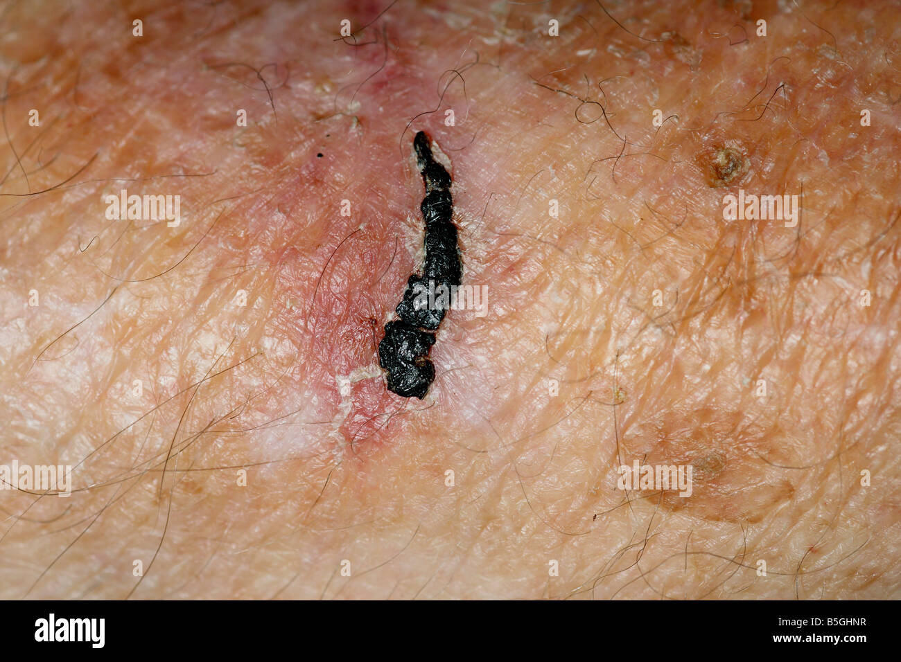 skin thinning on a elderly man's arm Stock Photo