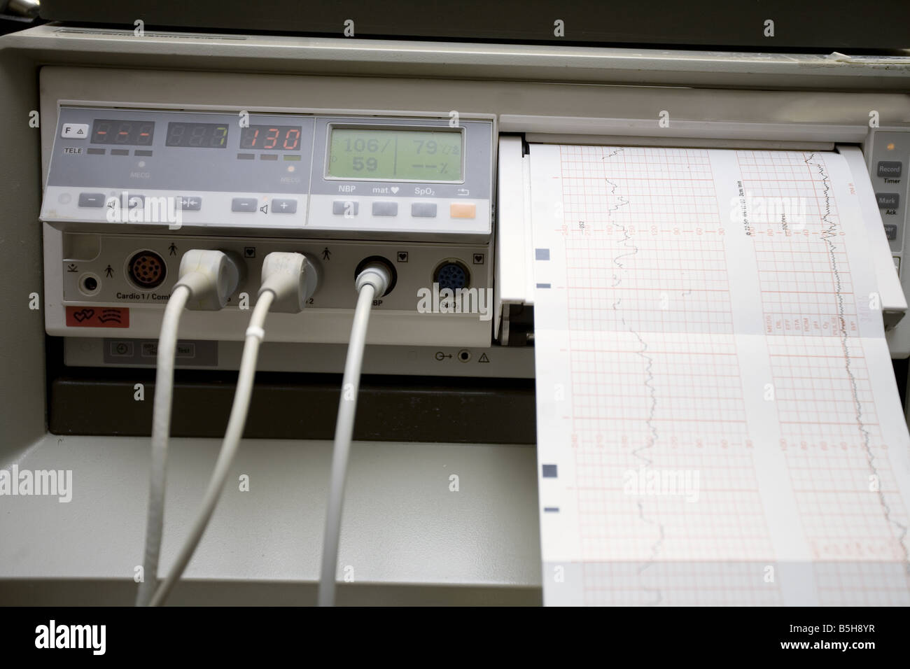 Fetal monitoring device during labor and childbirth delivery Stock
