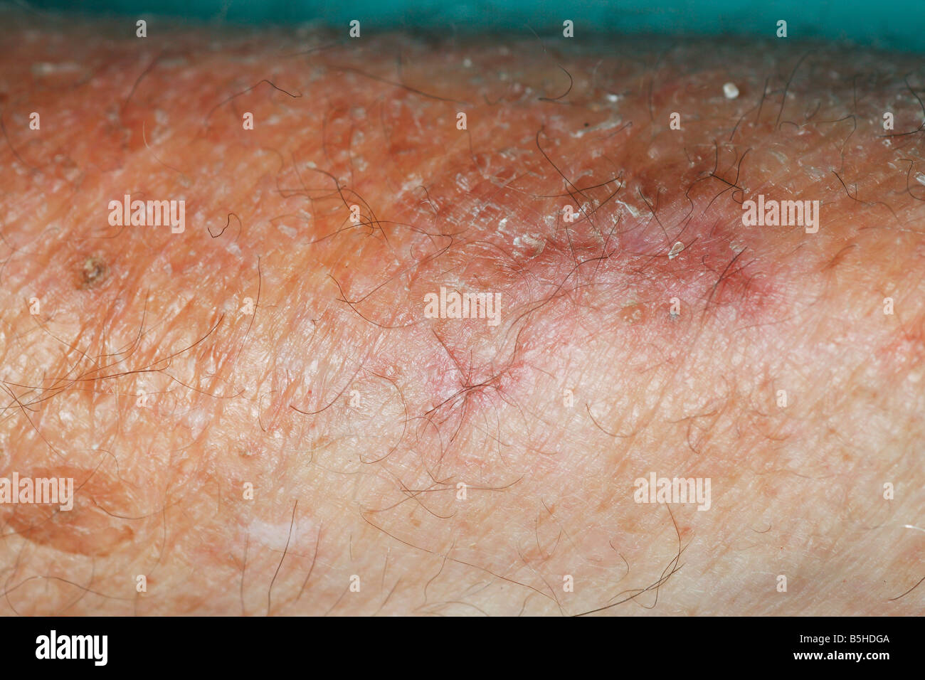skin thinning or atrophy on an elderly man's arm Stock Photo