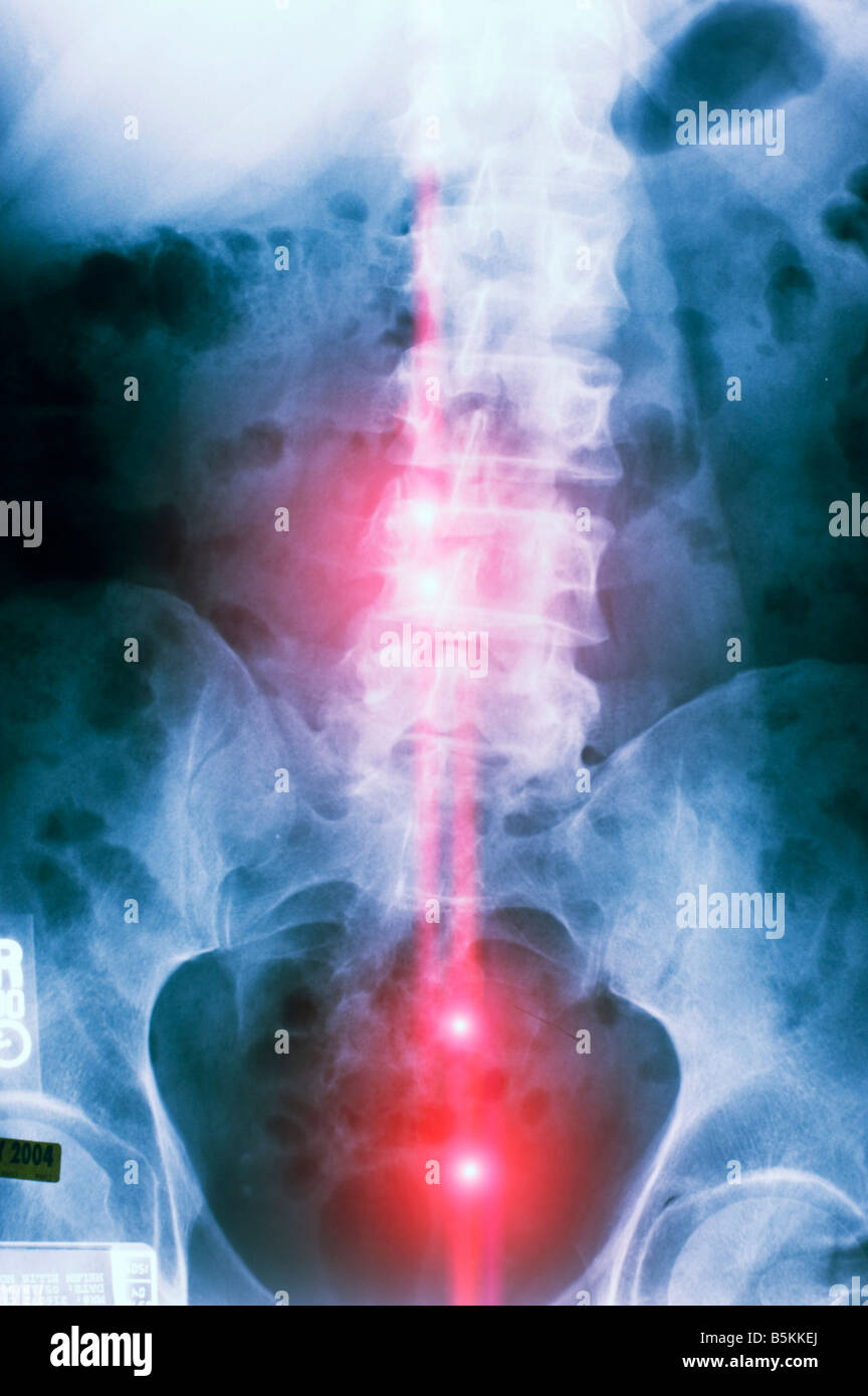 color coded x-ray of diseased human spinal column Stock Photo