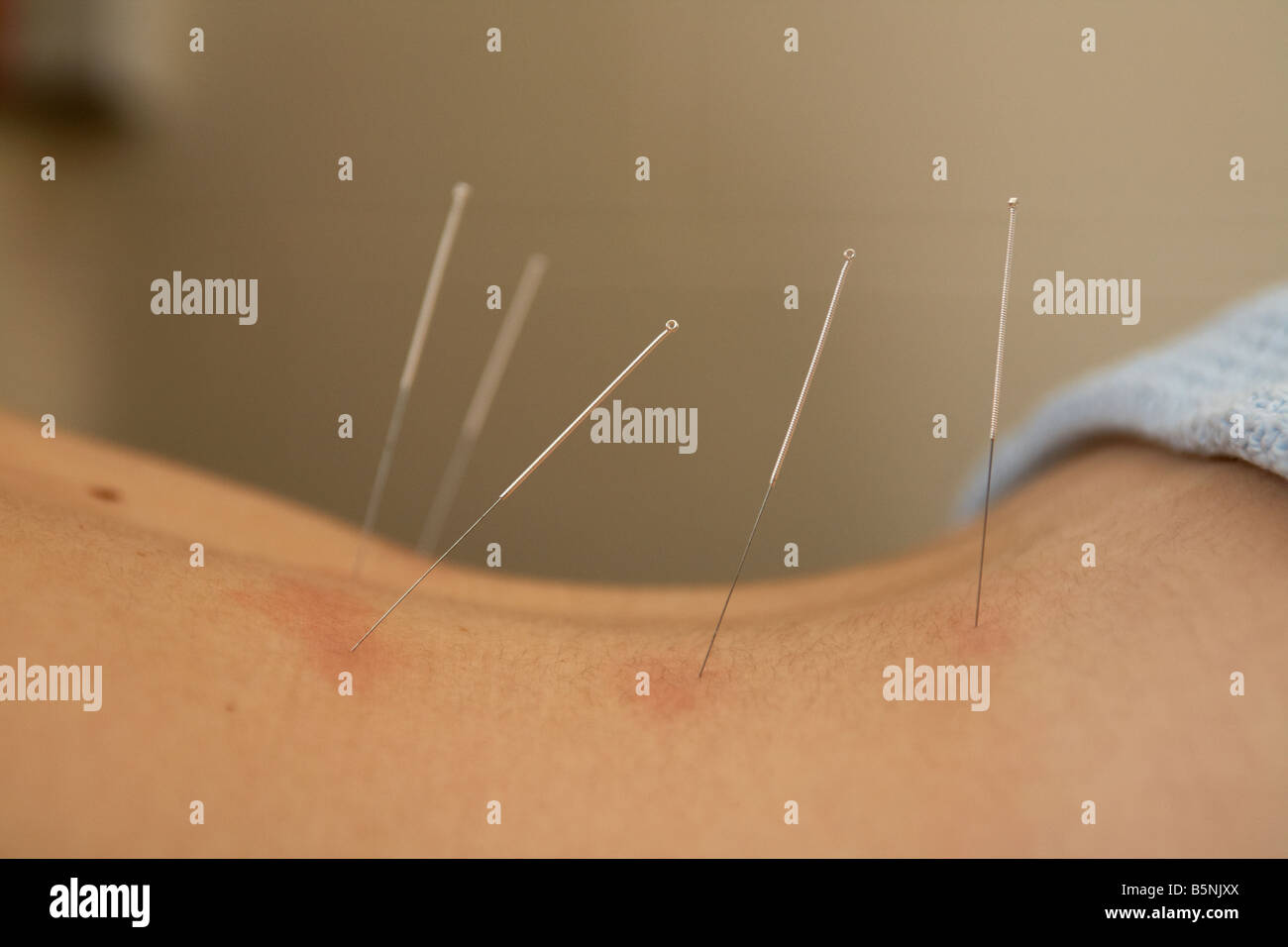 Acupuncture points pressure hi-res stock photography and images - Alamy