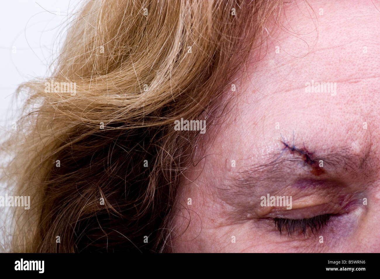 A senior woman with a sutured cut over her eye Stock Photo