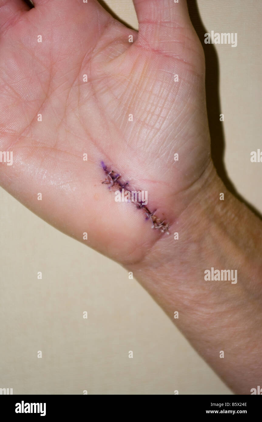 8 Surgical Stitches in a Hand Wound Post Op Carpal Tunnel Stock Photo