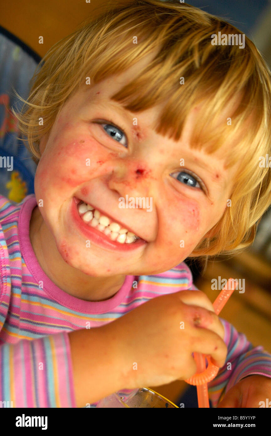 Child recovering from Chicken Pox Stock Photo