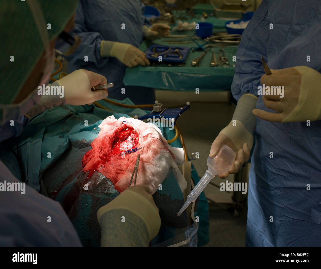 Neurosurgeons removing a benign brain tumor, Reykjavik, Iceland Stock Photo