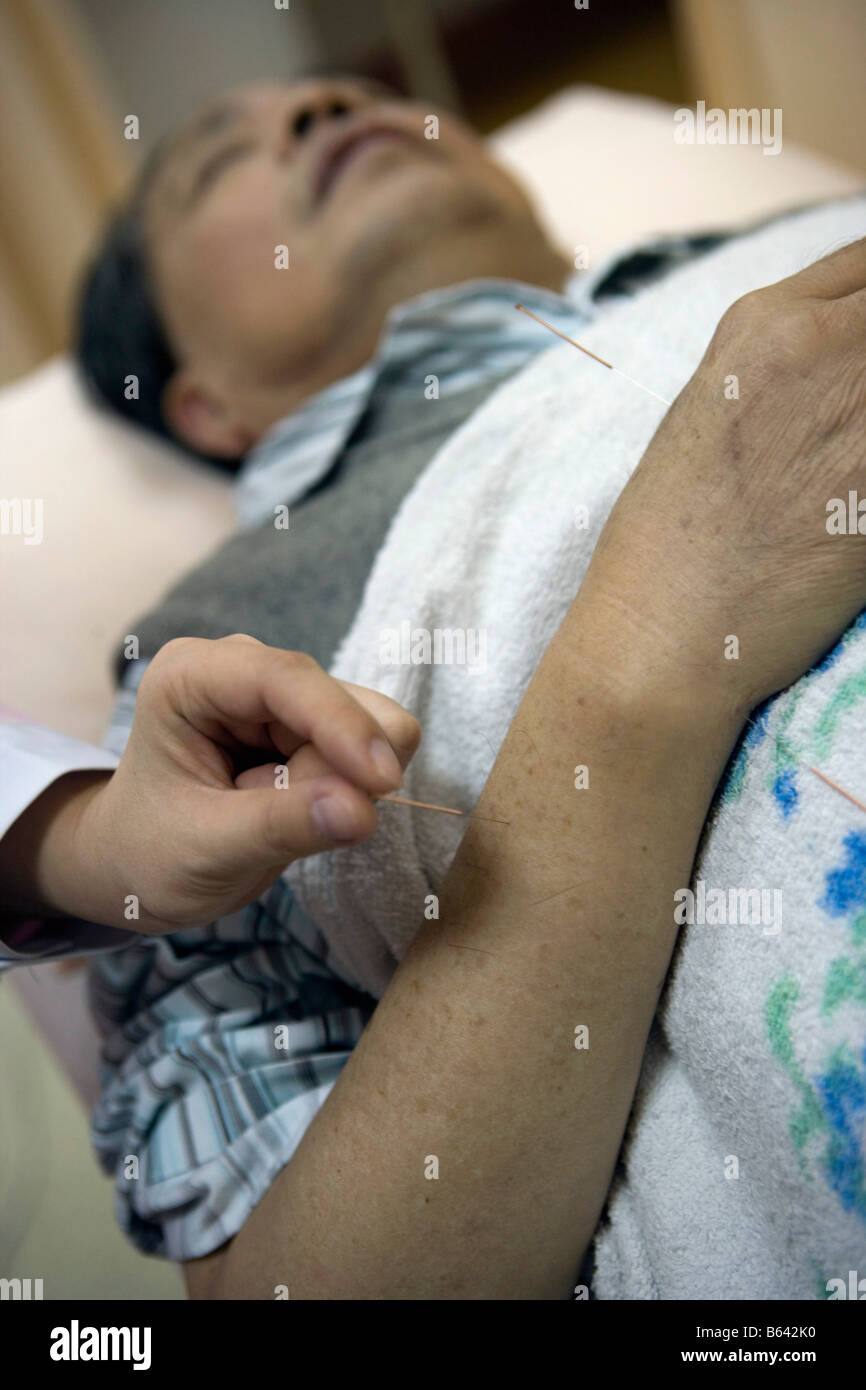 China,Shanghai,Shu Guang Hospital.(Traditional Chinese Medicine). Applying acupuncture on man who suffered a brain haemorrhage Stock Photo