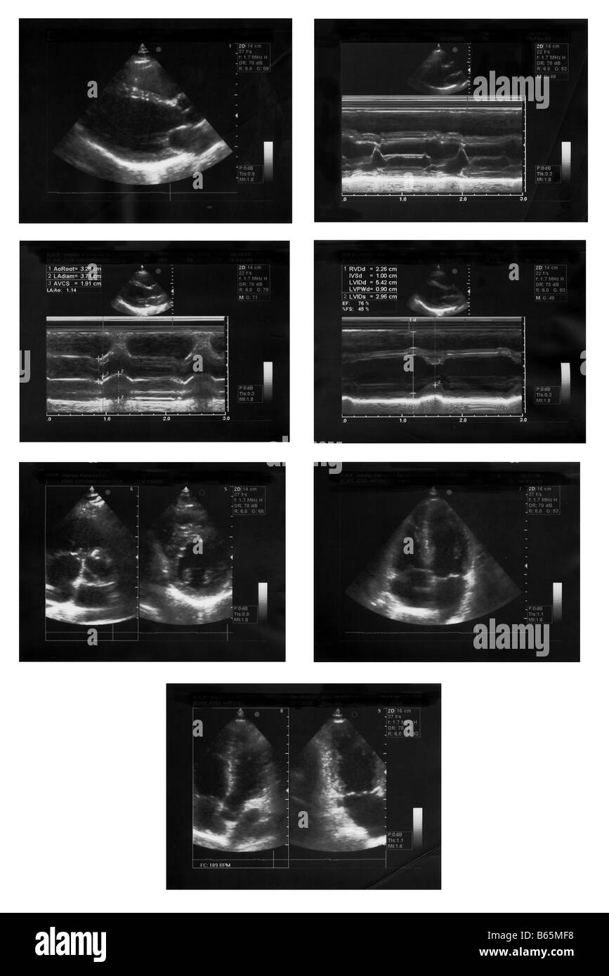 Echocardiography of a healthy adult male heart. High resolution scan. Stock Photo