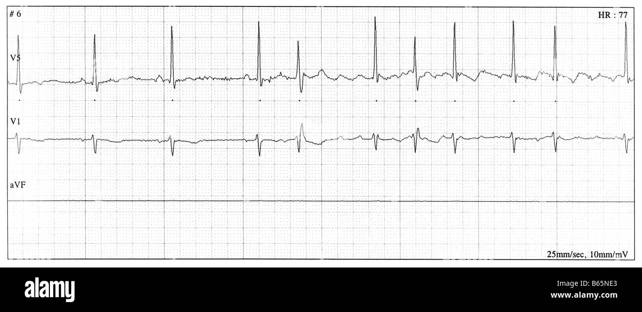 Result of a Treadmill Stress Test showing Atrial Fibrillation. Exam from a 34 year old male. Stock Photo
