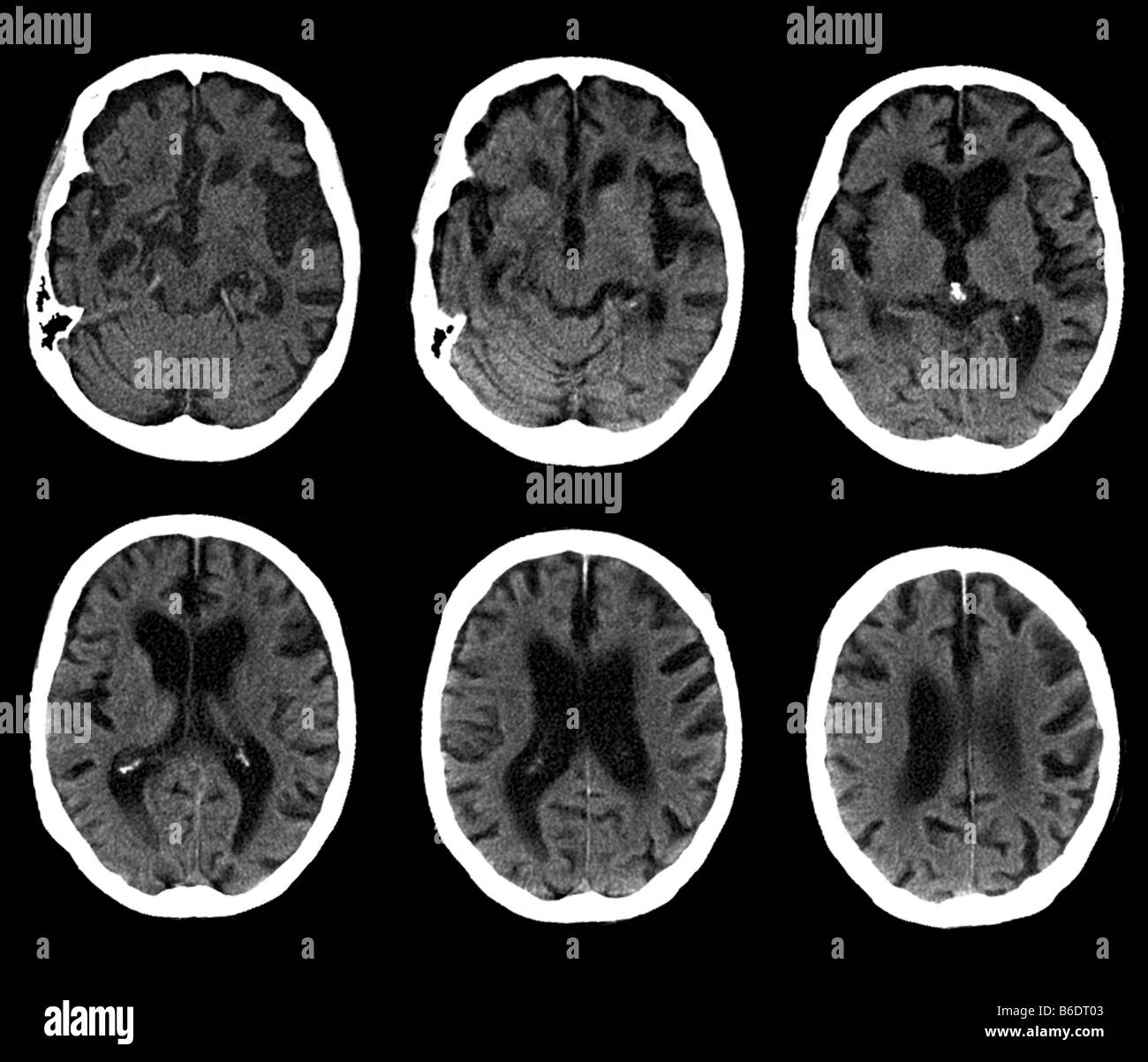Alzheimer's Disease Brain CT Scan