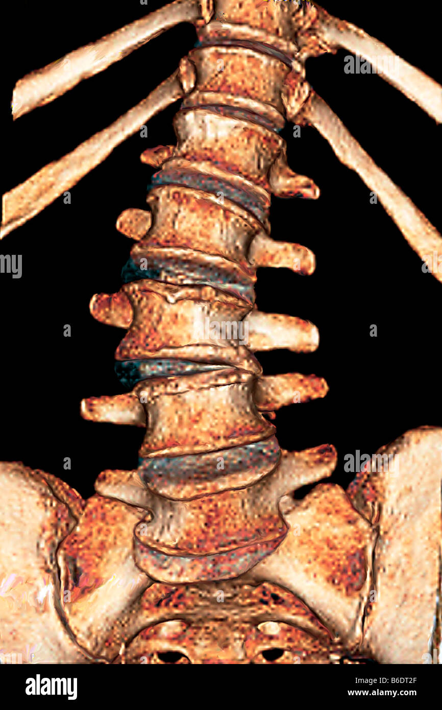 Arthritis Bone Spine High Resolution Stock Photography and Images Alamy