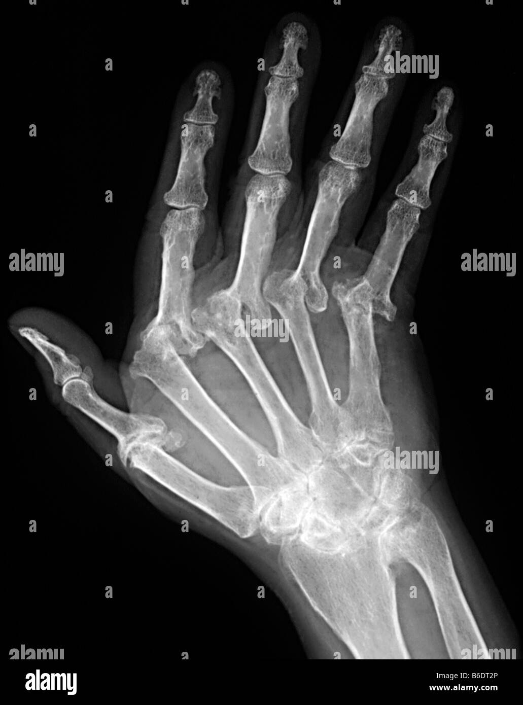 Arthritic hand. X-ray of the hand of a patient with severe rheumatoid arthritis in all of their fingers. The thumb is at left. Stock Photo