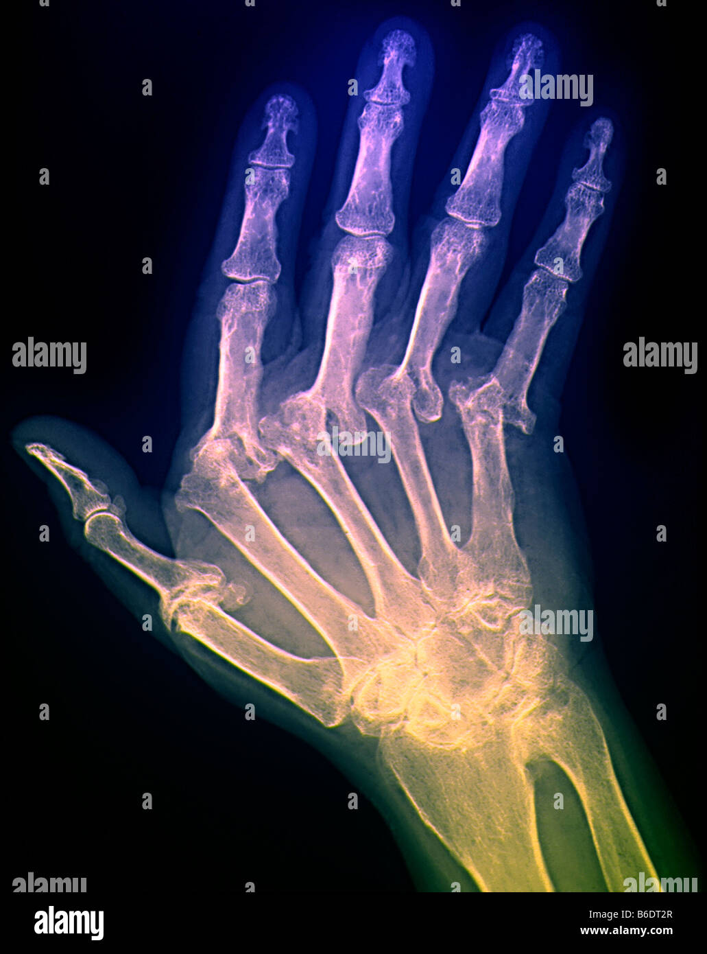 Arthritic hand. X-ray of the hand of a patient with severe rheumatoid arthritis in all of their fingers. The thumb is at left. Stock Photo
