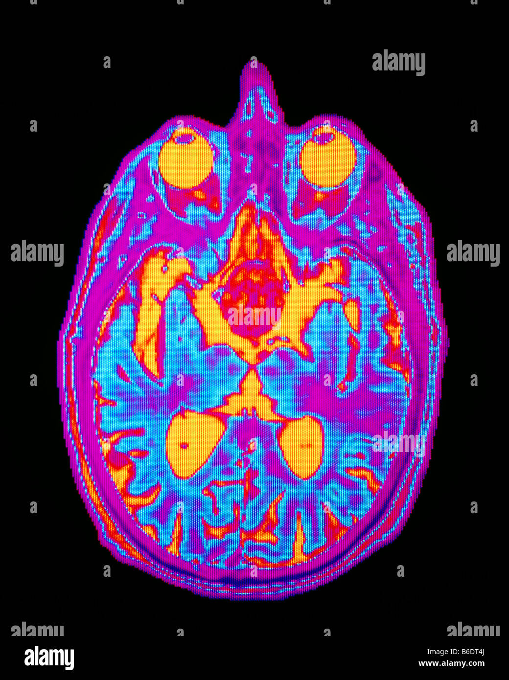 Pituitary tumour: false-colour magnetic resonanceimage (MRI) of an axial section of the brainshowing a large pituitary adenoma. Stock Photo