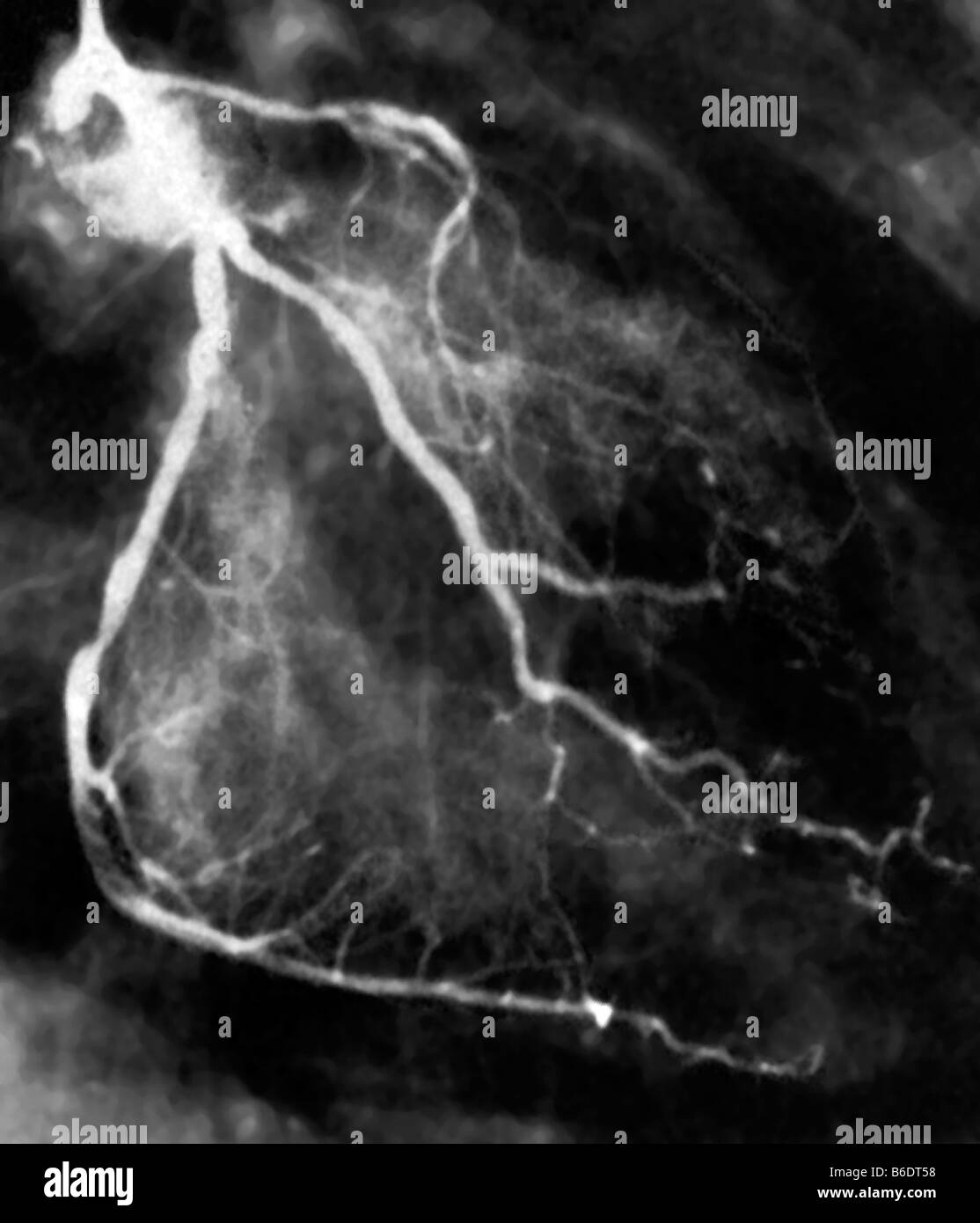 Narrowed coronary arteries. Coronary angiogram (X-ray) of a 59 year old patient. Stock Photo