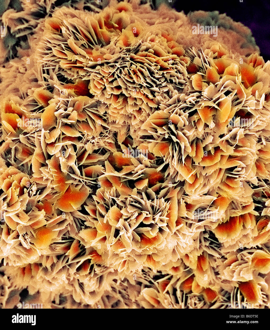 Kidney stone crystals, coloured scanningelectron micrograph (SEM Stock