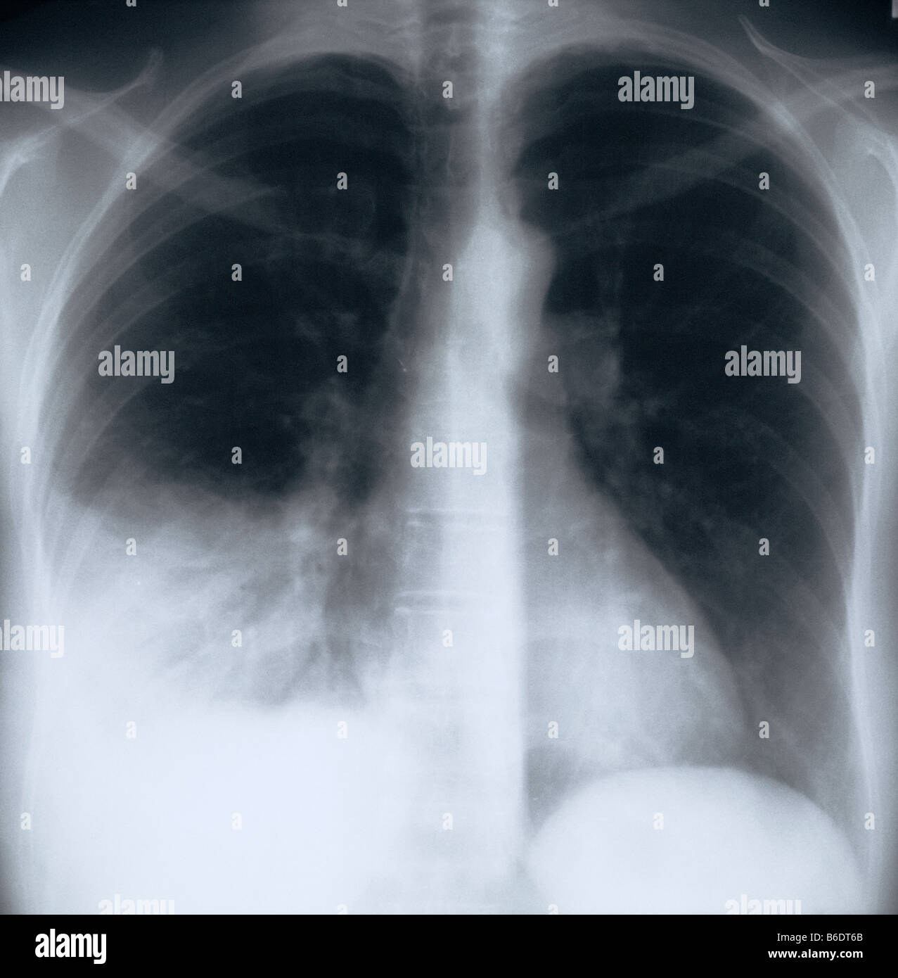 Pneumonia. Xray of the chest of a patient with bacterial pneumonia in
