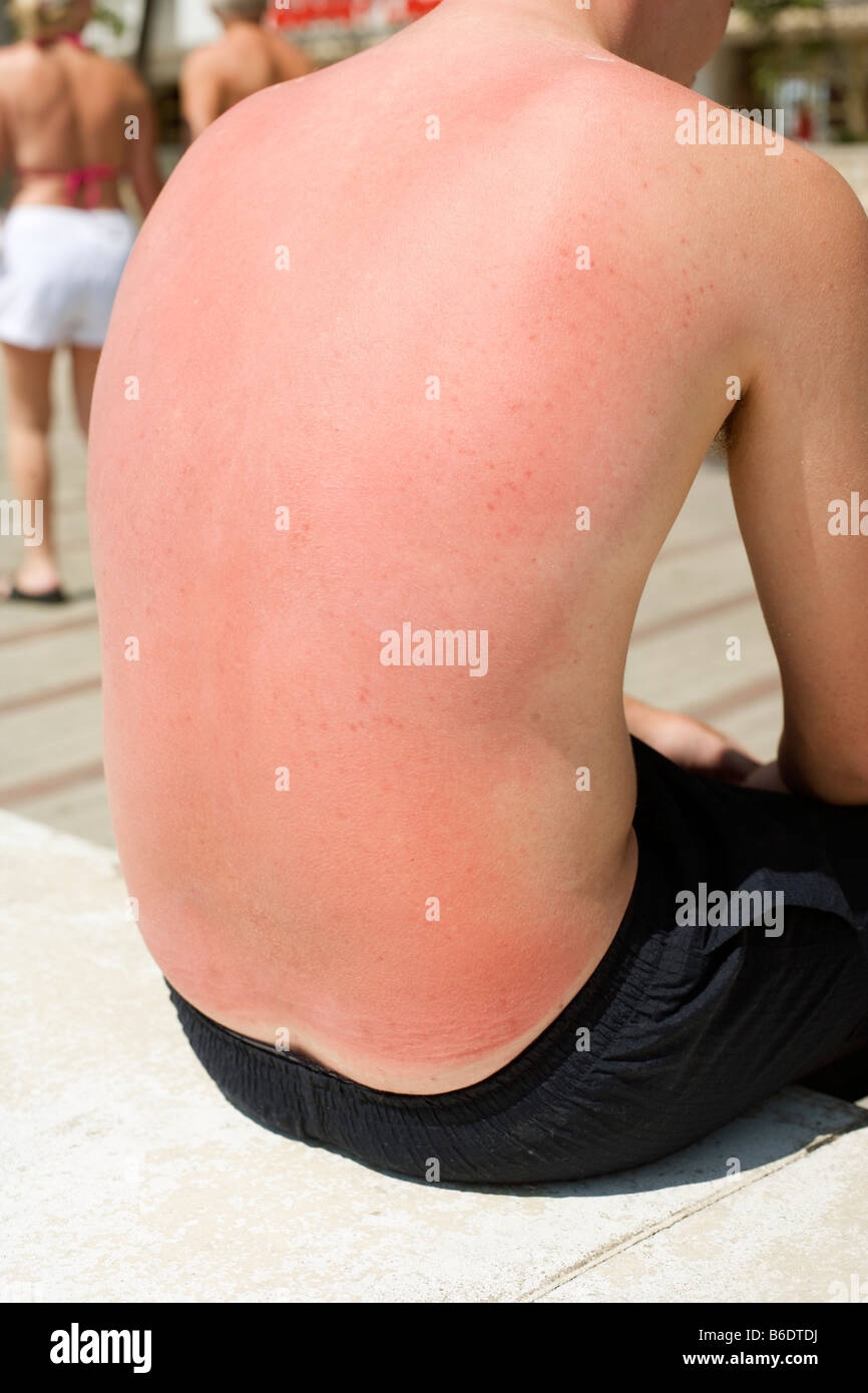 Sunburnt on the back of a twenty year old man. Sunburn is caused by overexposure to sunlight. Stock Photo