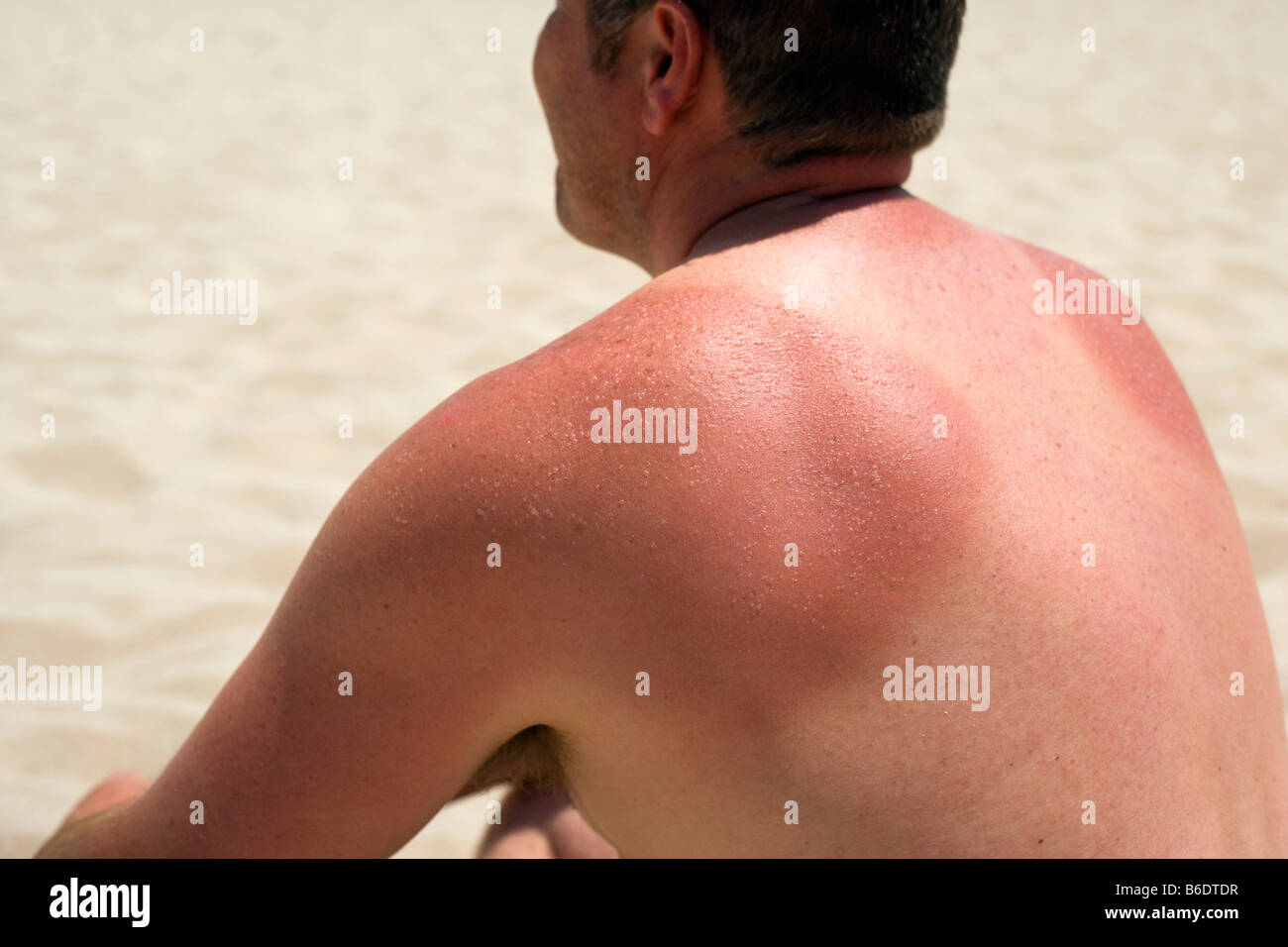 Man with sunburnt shoulders sitting on a beach. Sunburn is caused by overexposure to sunlight Stock Photo