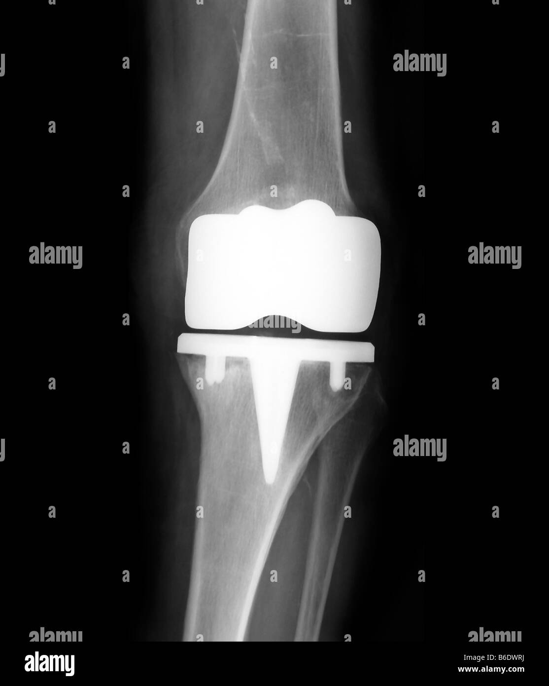 Prosthetic Knee Joint. Frontal X-ray Of A Patient With A Prosthetic ...