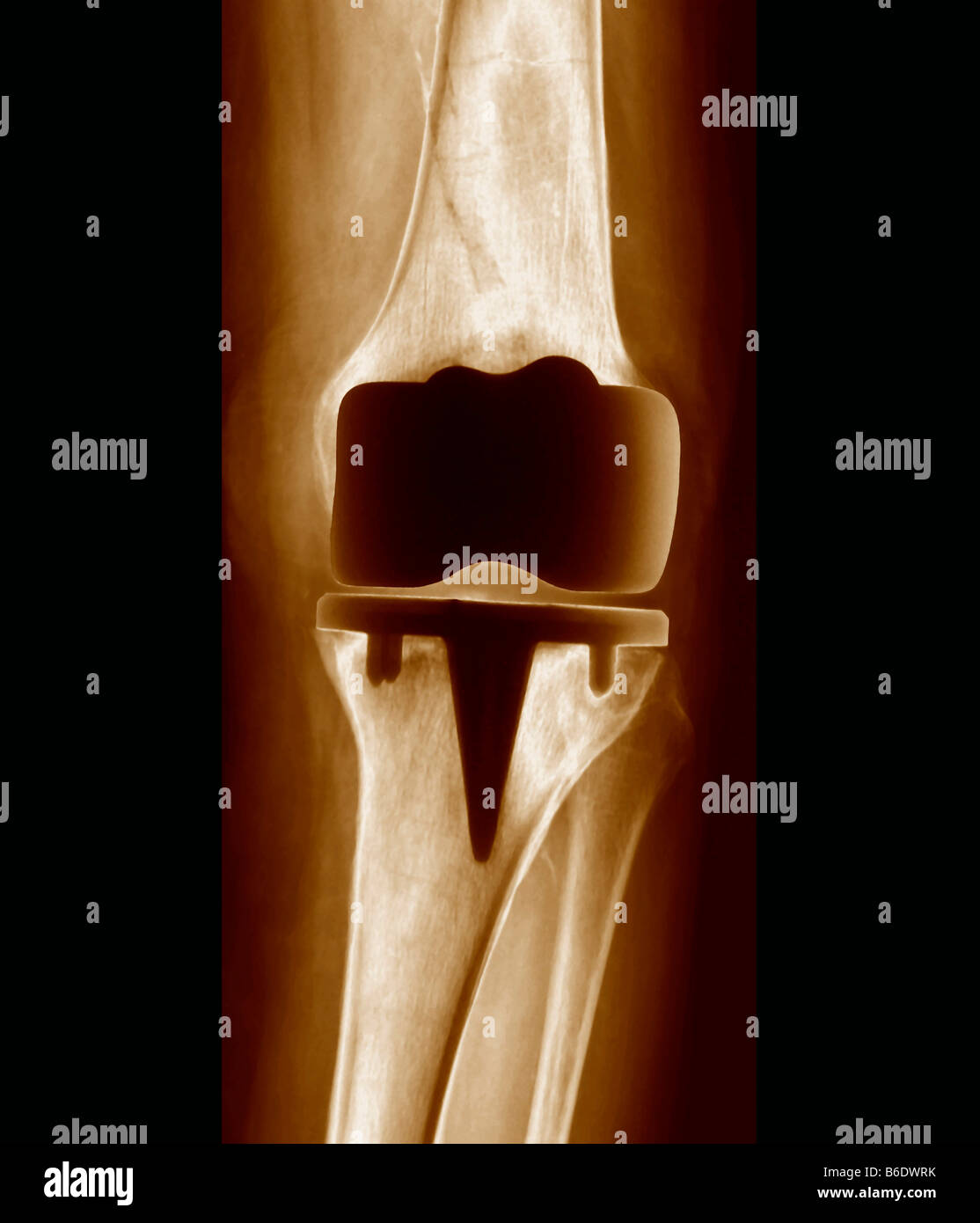 Prosthetic knee joint. Frontal Xray of a patient with a prosthetic