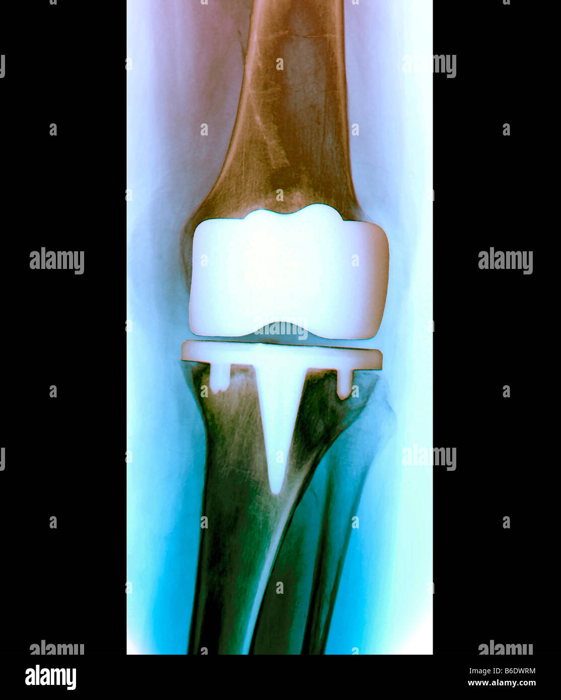 Prosthetic knee joint. Frontal Xray of a patient with a prosthetic