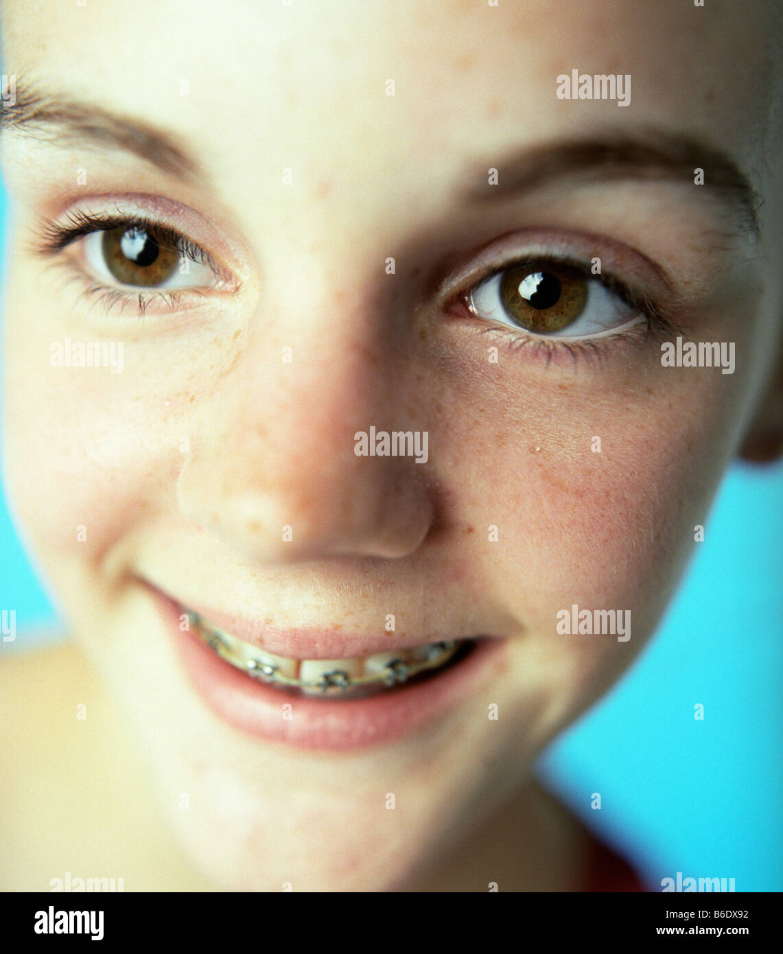 Dental braces fixed to the teeth of a 13yearold girl. Fixed braces