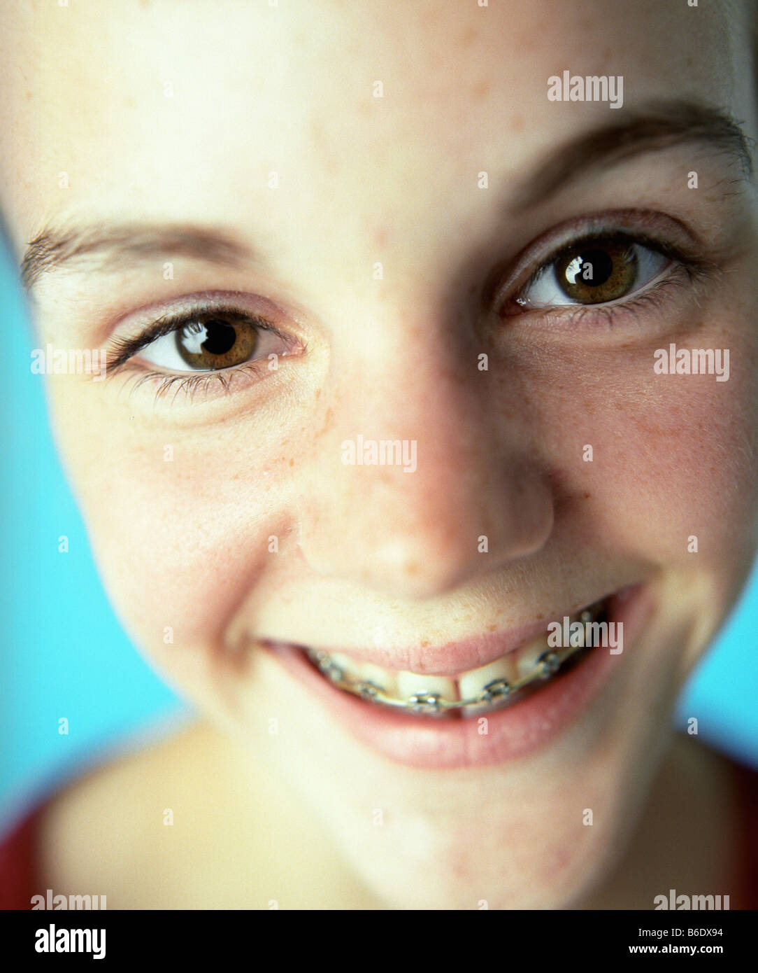 Dental braces fixed to the teeth of a 13yearold girl. Fixed braces