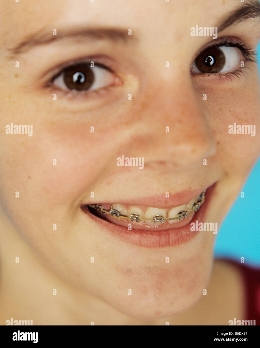 Dental braces fixed to the teeth of a 13yearold girl. Fixed braces