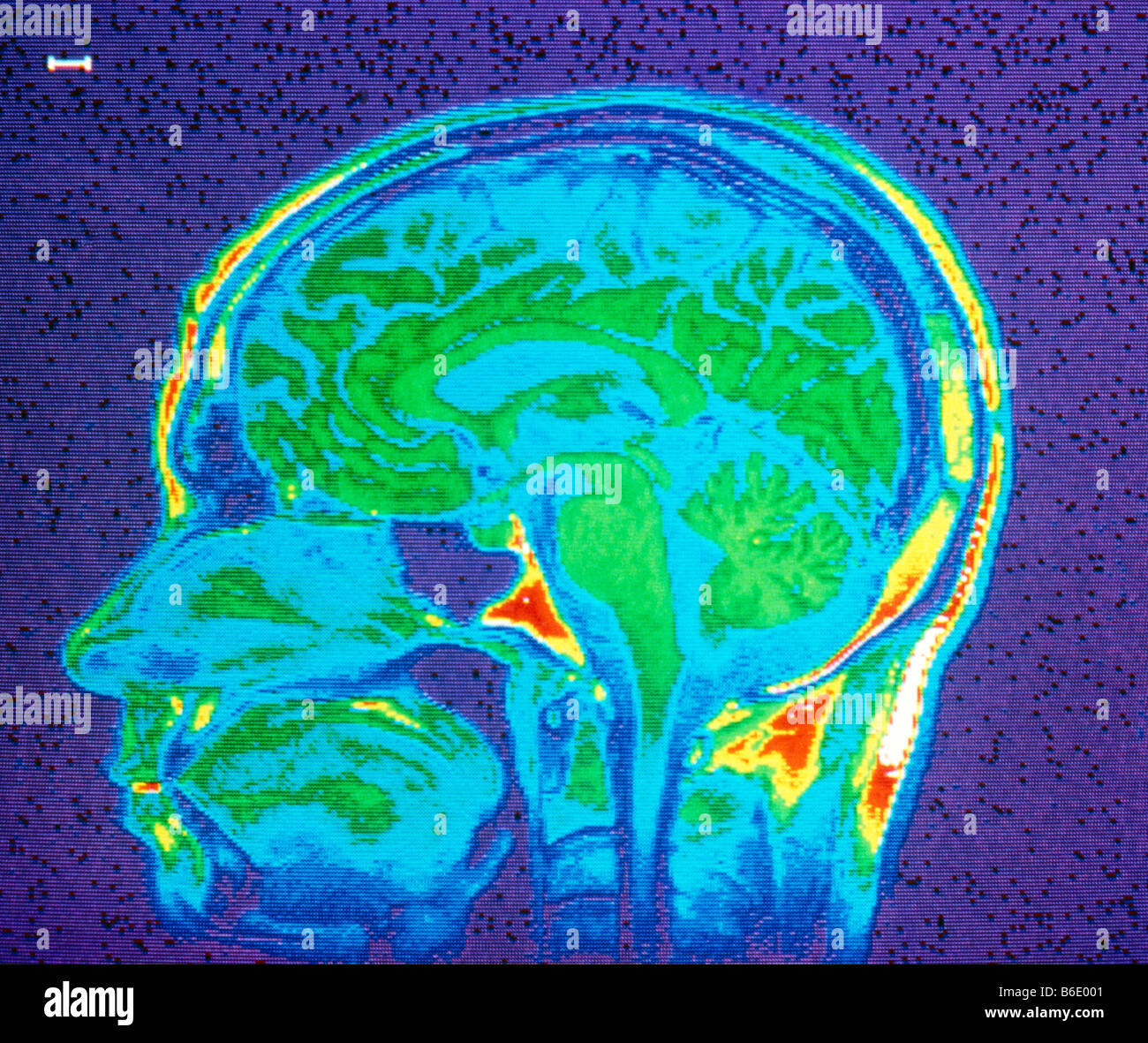 Nuclear resonance (NMR) image of a midsagittal section