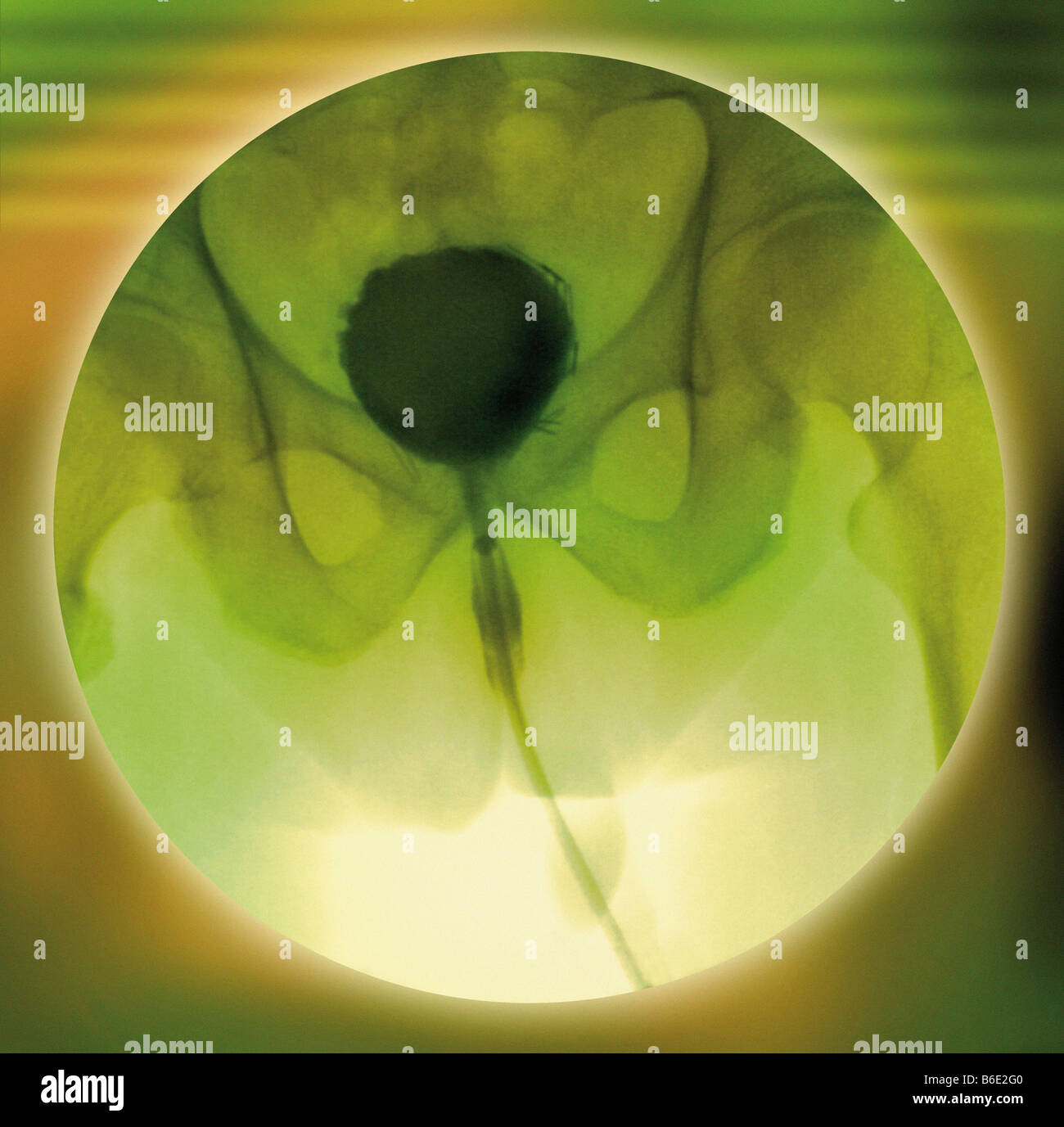 Normal bladder, coloured cystogram (bladder X-ray). Stock Photo