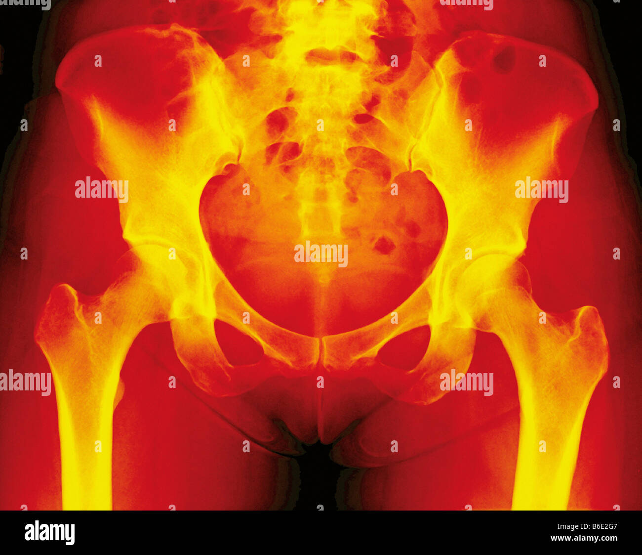 Normal female pelvis, coloured frontal X-ray. Thethigh (femur) bones of the leg are seen at bottomleft and right. Stock Photo
