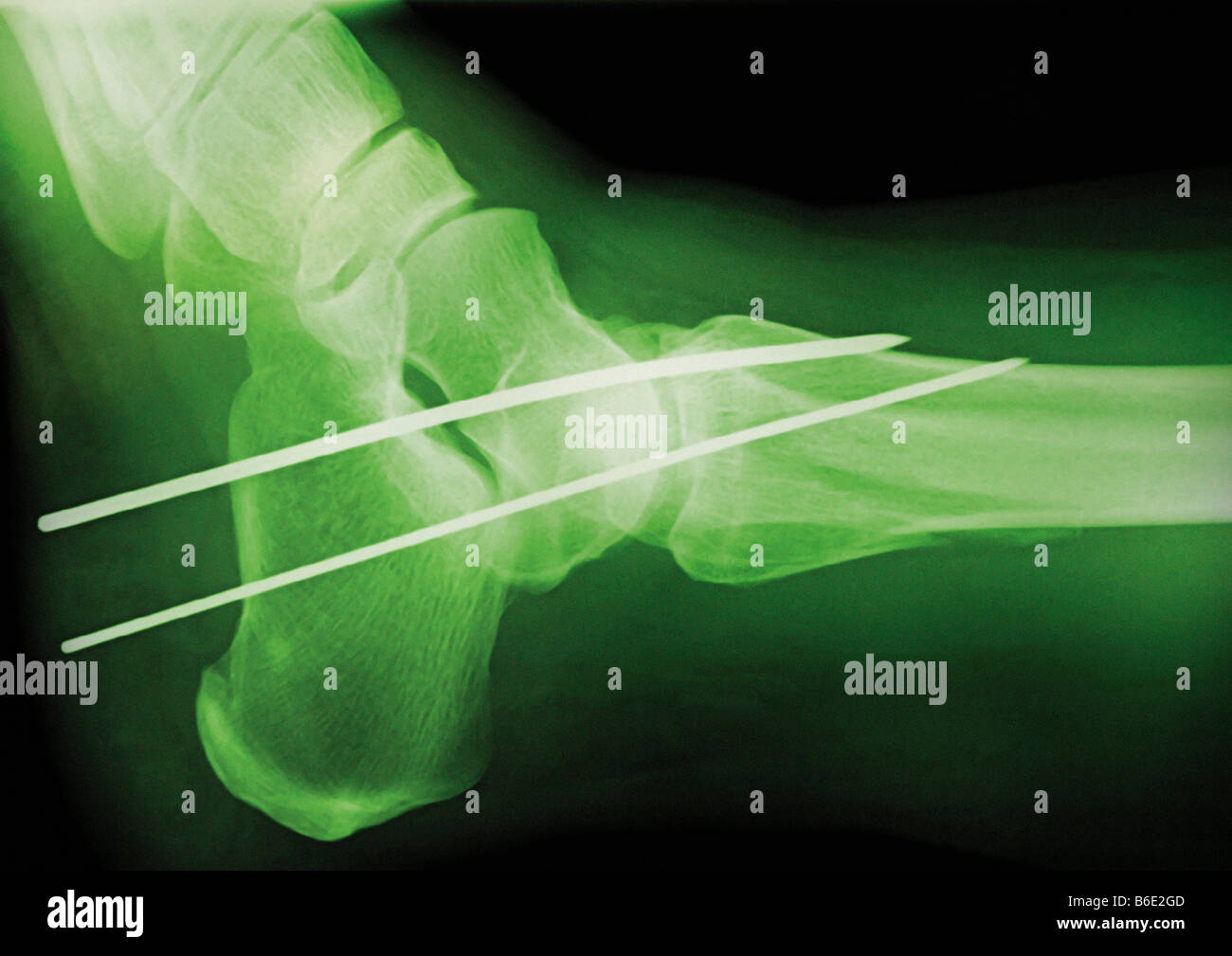 Fixation of ankle hires stock photography and images Alamy