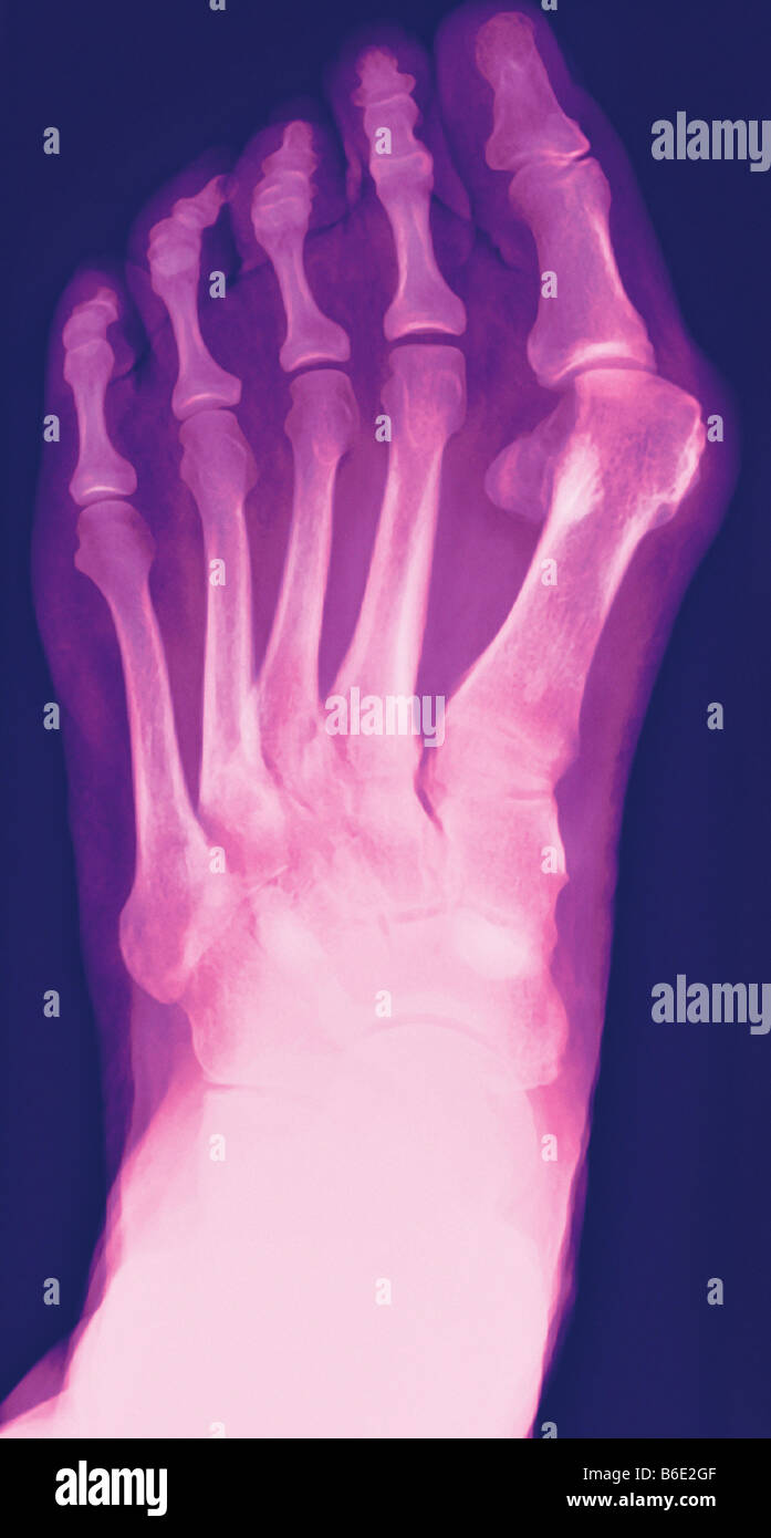 Bunion. Coloured Xray of a bunion (hallux valgus, upper right), the
