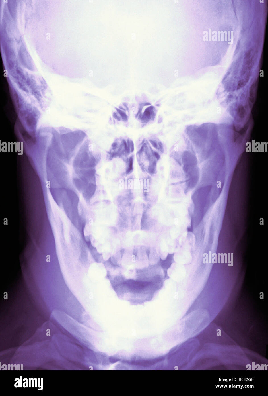 Normal Skull X Ray High Resolution Stock Photography and Images Alamy