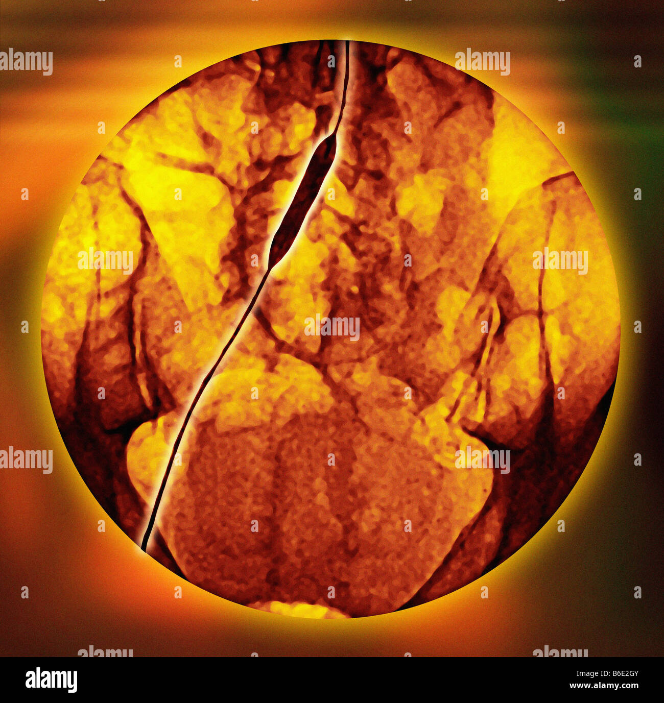 Iliac artery angioplasty. Coloured angiogram of aniliac artery with a balloon catheter. Stock Photo