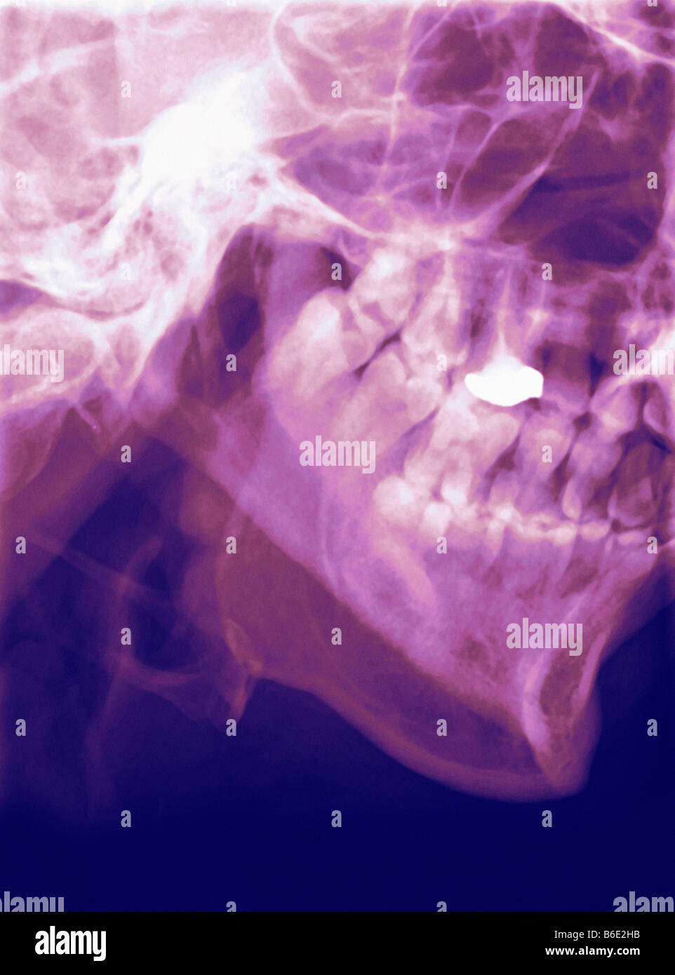 Normal lower jaw. Coloured profile Xray of a human mandible (lower jaw