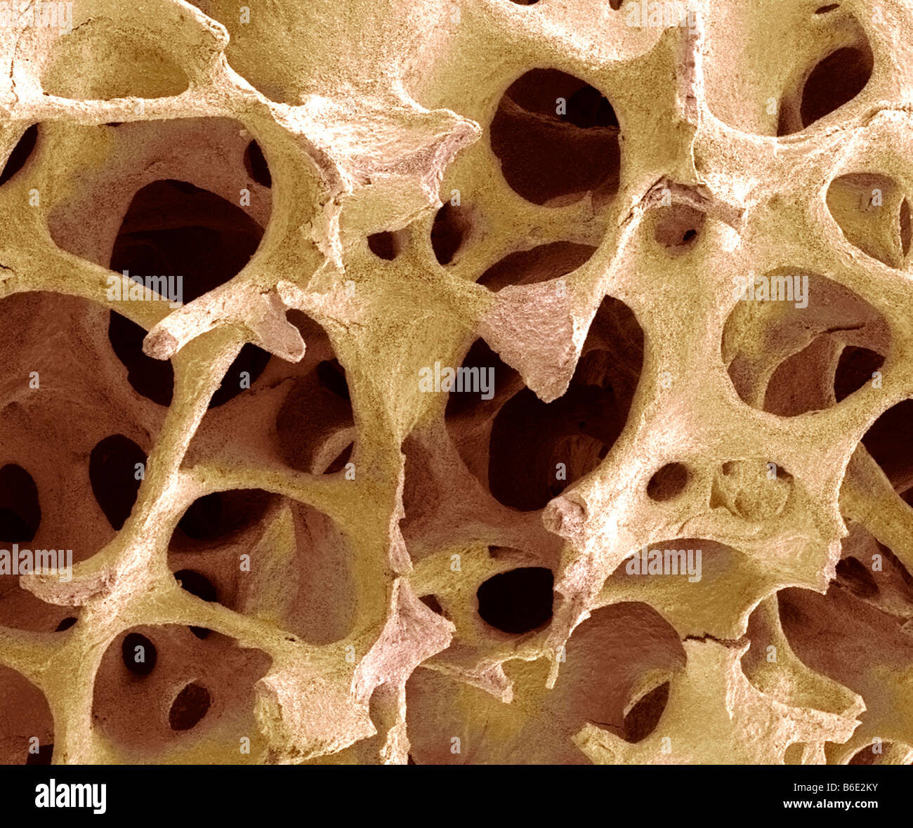 Close-up of normal human spongy bone - Stock Image - P105/0067 - Science  Photo Library