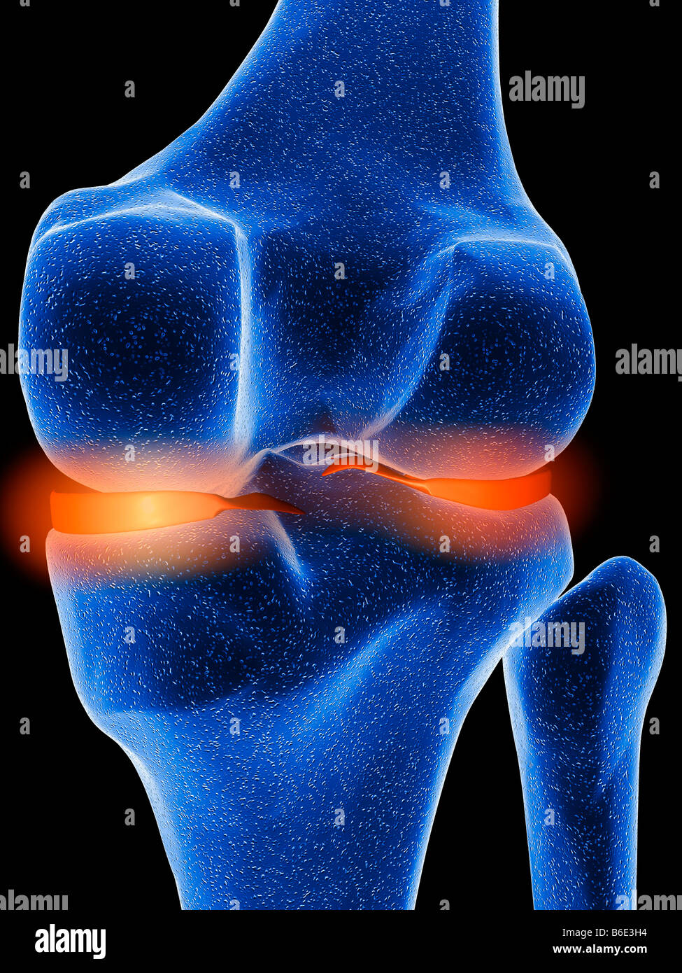 Inflamed knee cartilage against black background Stock Photo Alamy