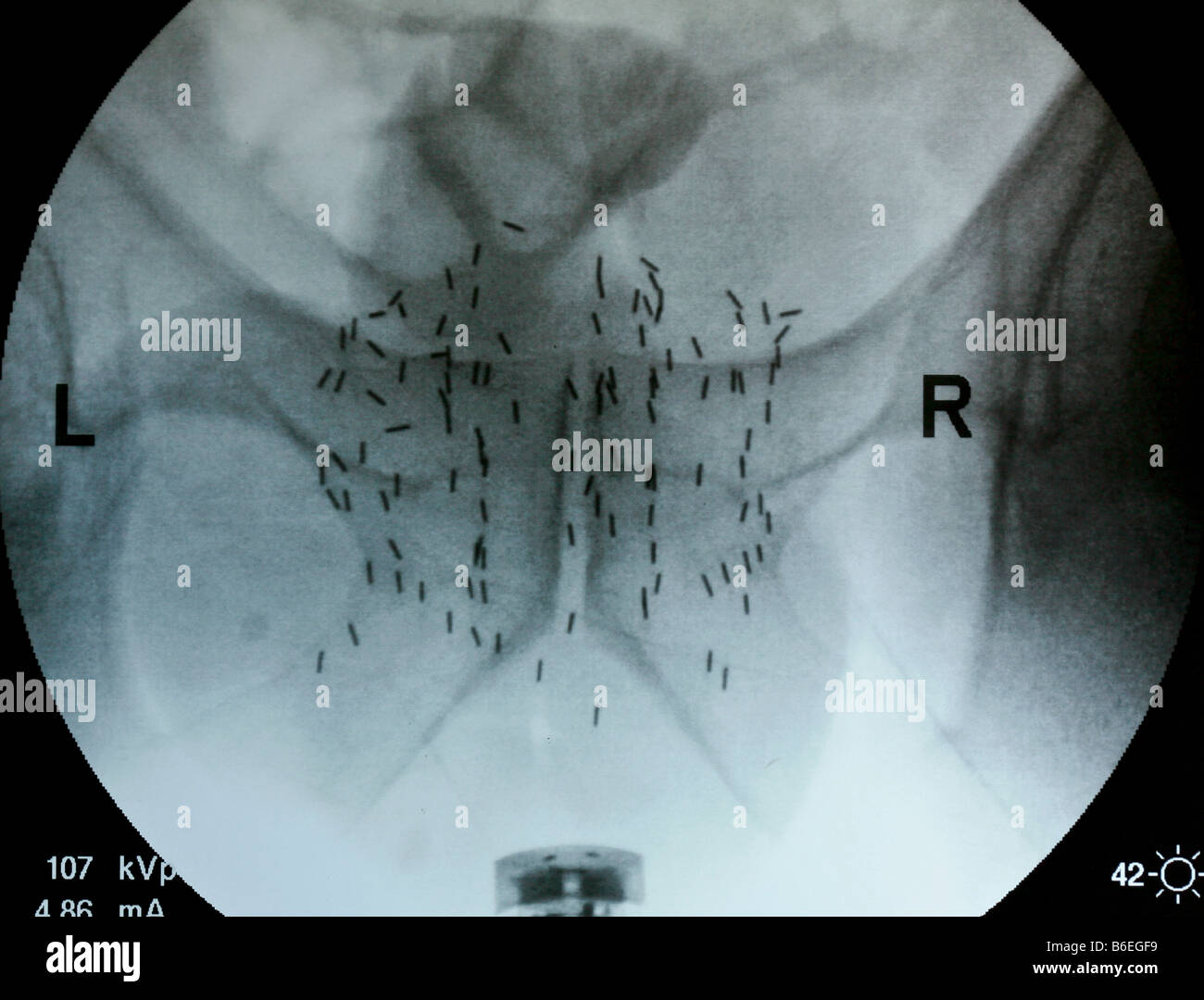 xray of male pelvis with radioactive iodine seeds in the prostate Stock ...